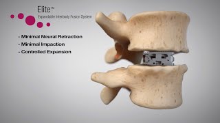 Elite™ Expandable Interbody Fusion System Animation [upl. by Vargas577]