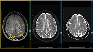 Demyelination Case Review  ADC Negative Multiple Sclerosis [upl. by Niotna]