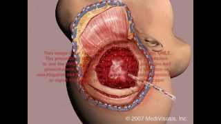 Craniotomy Surgery [upl. by Alym560]