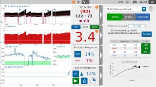 How to give a guided fluid challenge  LiDCO US [upl. by Haines]