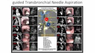 EBUSCTBronchoscopy Poster [upl. by Llerraj]