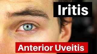 Iritis  What is Anterior Uveitis Doctor Explains [upl. by Chaddie796]