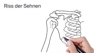 Behandlung einer Rotatorenmanschette by ATOS Kliniken [upl. by Ahsekel]