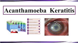 Acanthamoeba Keratitis [upl. by Schram]