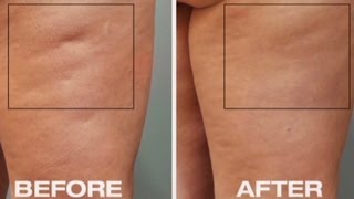 New tool to fight cellulite [upl. by Merfe686]