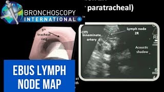 Flexible Bronchoscopy Basic Techniques 5  Brushing [upl. by Adnahs]