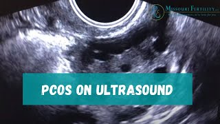 PCOS Sonogram and Discussion [upl. by Nosnev]