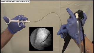 Transbronchial Biopsies  BAVLS [upl. by Aneela]