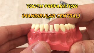 CROWN PREPARATION TUTORIAL MANDIBULAR CENTRAL [upl. by Novehc123]