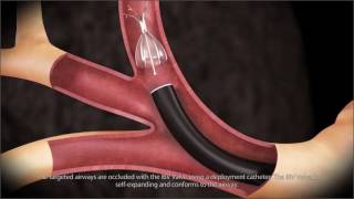 Bronchial Blockers EZBlocker [upl. by Fitzhugh]