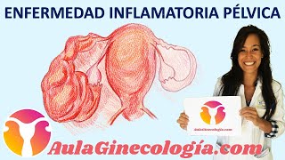 ENFERMEDAD INFLAMATORIA PÉLVICA EPI Síntomas y tratamiento  Ginecología y Obstetricia [upl. by Goda]