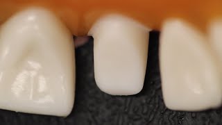 All Ceramic Crown Anterior Tooth Preparation [upl. by Ruthven]