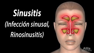 Sinusitis Animación Alila Medical Media Español [upl. by Sucramed271]