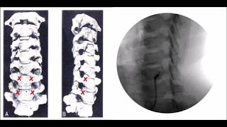 How to perform Stellate Ganglion Block Treatment [upl. by Harriott]