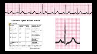 How to Determine Intervals amp Segments on EKG EXPLAINED [upl. by Amado]