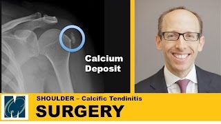 Calcific tendinitis of the shoulder [upl. by Camellia]