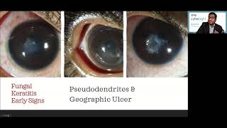 Lecture Microbial Keratitis Update for General Ophthalmologists [upl. by Sheaff]