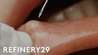 I Got My Botched Lip Filler Popped  Macro Beauty  Refinery29 [upl. by Odarnoc386]