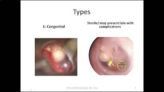 ENT Cholesteatoma Types Treat Wittmaack Ruedi Sade Habermann Laws view Classify [upl. by Eelirol]