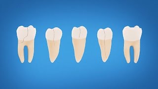 Understanding Cracked Tooth Treatment and Symptoms [upl. by Eardnoed]