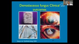 Lecture Fungal Keratitis [upl. by Nauqe]