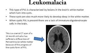 Periventricular Leukomalacia [upl. by Eiramanel]