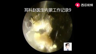 Cleaning cholesteatoma of external auditory canal and tympanic enucleation with otoendoscopy [upl. by Allisan]