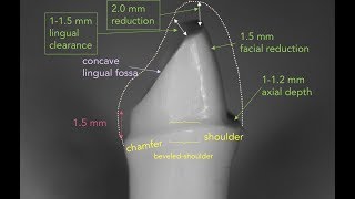 Anterior PFM Preparation  Dr Richard Stevenson [upl. by Eiramenna862]