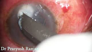 Therapeutic Corneal Ulcer Scraping [upl. by Alyat490]