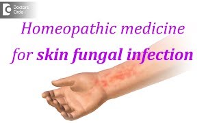 Homeopathic medicine for skin fungal infection  Dr Surekha Tiwari [upl. by Armilla]