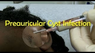 Preauricular Cyst Infection Management [upl. by Moyna434]