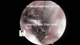 Management of external auditory canal cholesteatoma under anesthesia 11 min [upl. by Ahtelra]