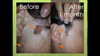 Natural treatment for seborrheic keratosis before and after photos [upl. by Frazier714]