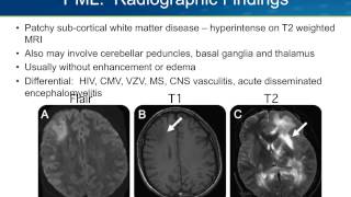 Progressive Multifocal Leukoencephalopathy PML [upl. by Halland460]