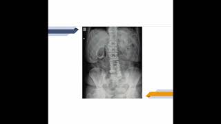 Calcificación abdominal [upl. by Jonell]