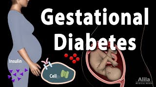 Gestational diabetes  NHS [upl. by Ybanrab]