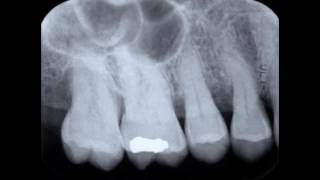 Paralleling Technique and Periapical Radiograph [upl. by Acirdna891]