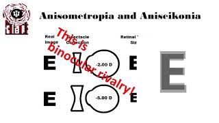 Anisometropic amblyopia [upl. by Areehs]