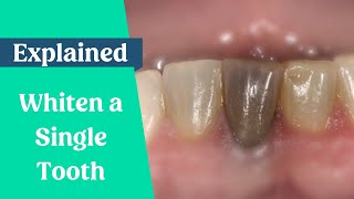 How to whiten a single dark tooth [upl. by Acinahs]