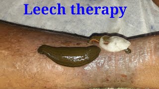 How to perform Leech therapy  JAULAKA treatment leeches on skin panchakarma ayurveda [upl. by Norahs]