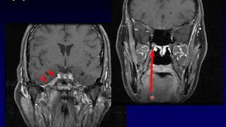 Imaging of the Nasopharynx [upl. by Adnoek]