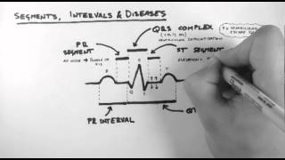 ECG 3  Segments Intervals amp Diseases [upl. by Ayidah]