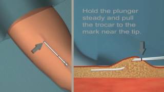 Jadelle insertion and removal Tutorial [upl. by Rediah]