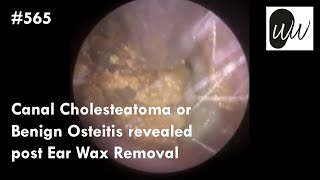 Cholesteatoma excised clip version of the external auditory canal 7 min [upl. by Amalee]