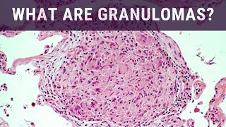 What are Granulomas  Pathology mini tutorial [upl. by Ardnaed183]