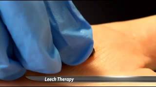 Hospital Uses Leeches to Heal Patients [upl. by Fletcher]