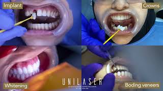 Smile Design Crowns Implants Veneers in Medellin Colombia [upl. by Lavine]