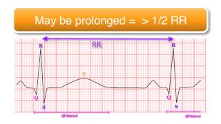 ECG basics 1010  The QT Interval [upl. by Teemus893]