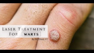 Warts removal with Laser Treatment  Dr Chiam CT [upl. by Cherian]