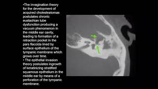 Chronic Suppurative Otitis Media Attico Antral type Unsafe Cholesteatoma [upl. by Xyla]